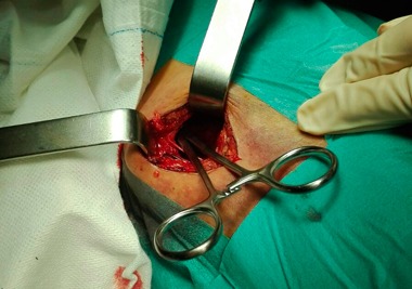 Curro Díaz operado de una cornada interna