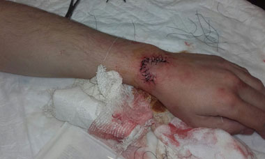 17 puntos de sutura antes de su debut en Olivenza