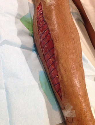 El calvario de Thomas Cerqueira se alarga: Trombosis venal en la femoral